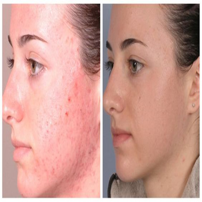 Hot sale Microdermabrasion Diamond Peeling Beauty Machine Factory Direktförsäljning
