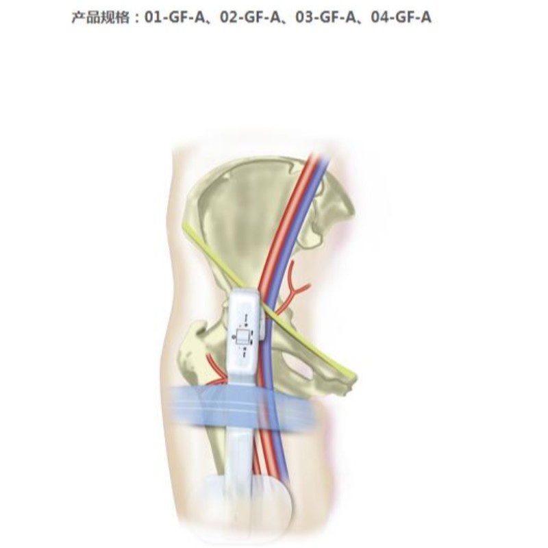 Goldfinger Electronic Femoral Hemostasis komprimeringsanordning