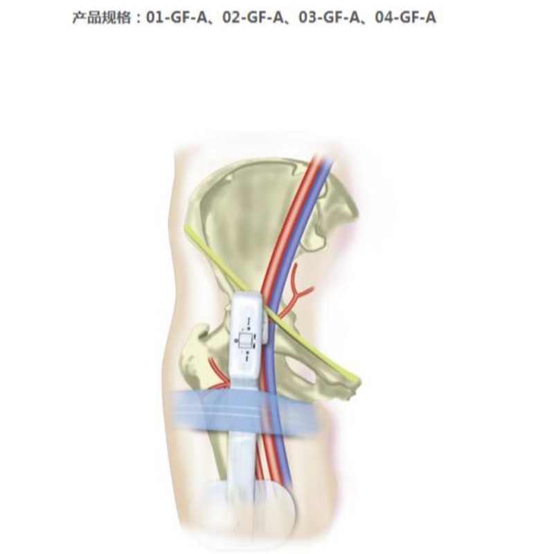 Goldfinger Electronic Femoral Hemostasis komprimeringsanordning